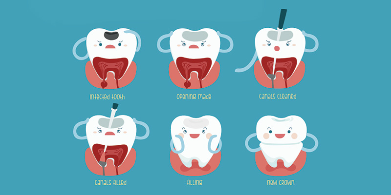 Endodonti (Kanal Tedavisi)