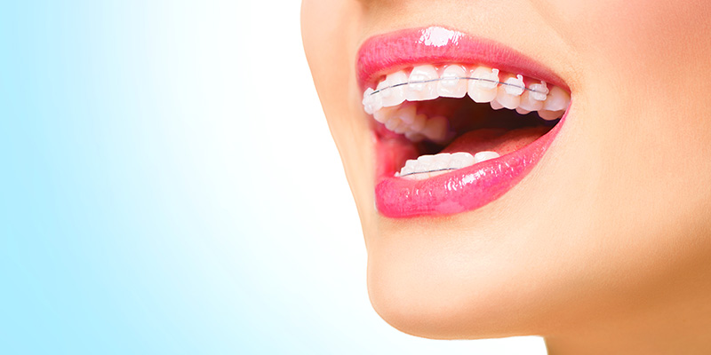 Traitement Orthodontique