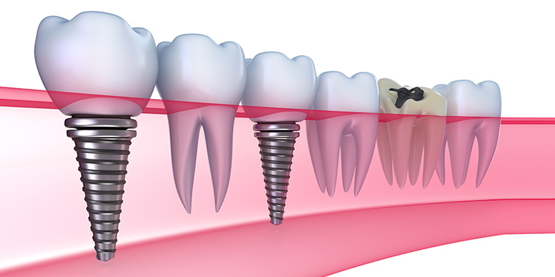 Tratamiento Implantológico