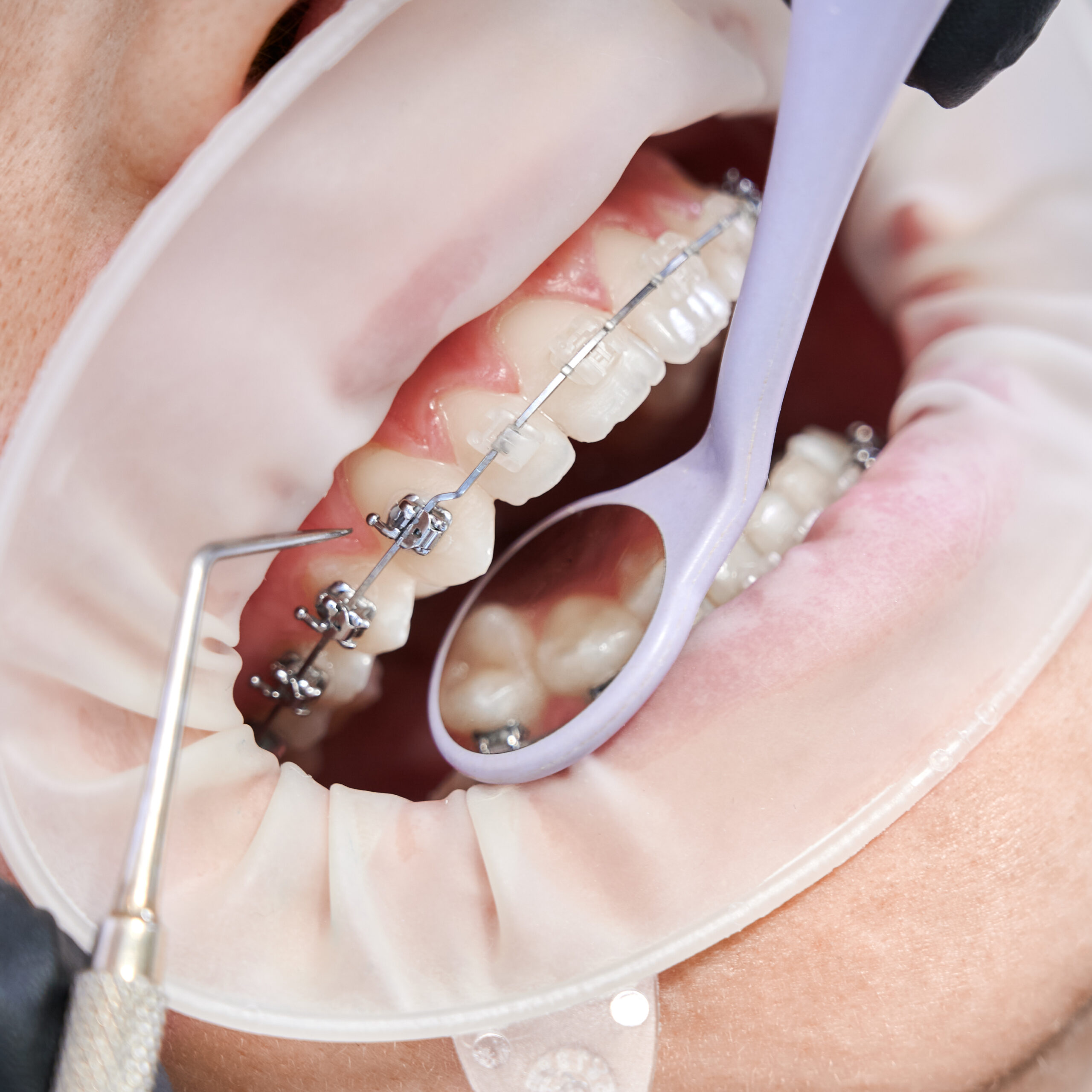 Dentist Attaching Metal Braces Patient Teeth.jpg Scaled