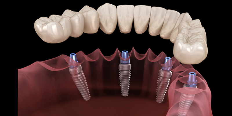 All-On-4 Tedavi̇si̇