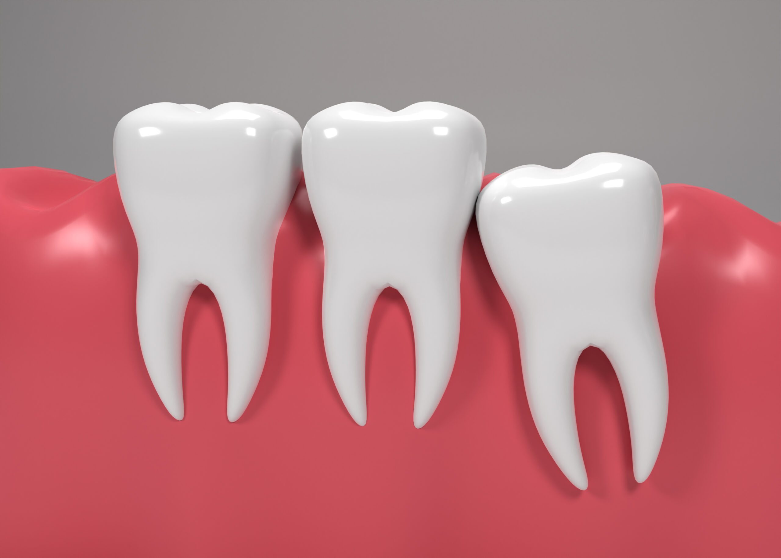 3D Render Teeth With Wisdom Mesial Impaction Scaled