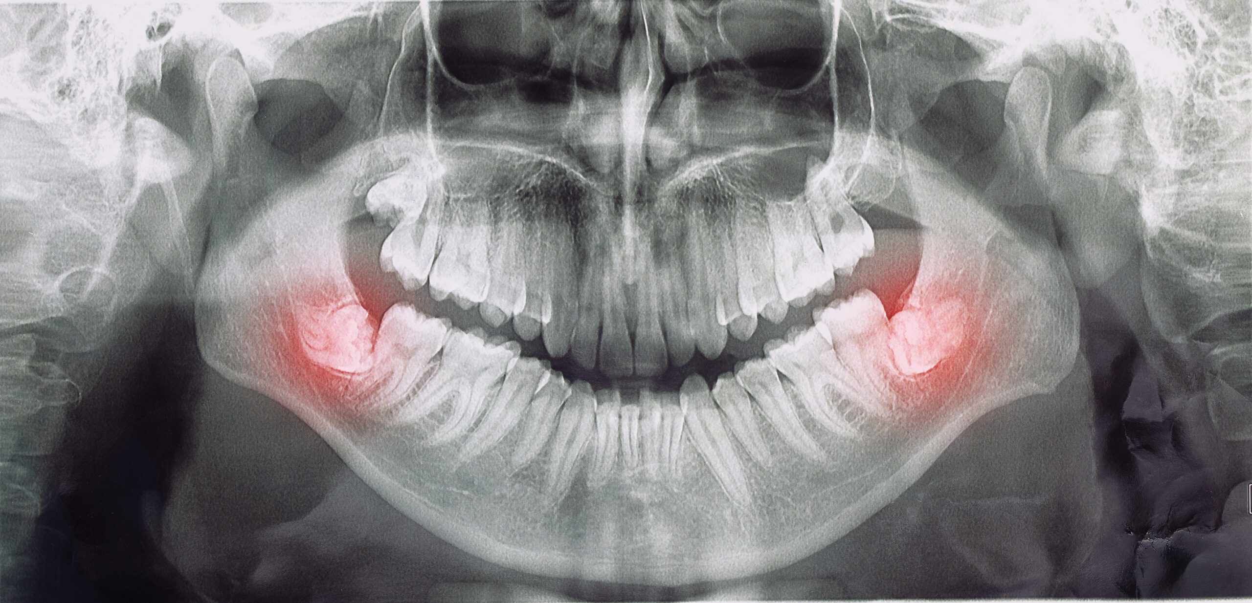 Different Types Wisdom Teeth Problems Concept Problem Teeth X Ray Image Scanned Panoramic Image Scaled