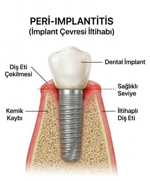 Peri Implant