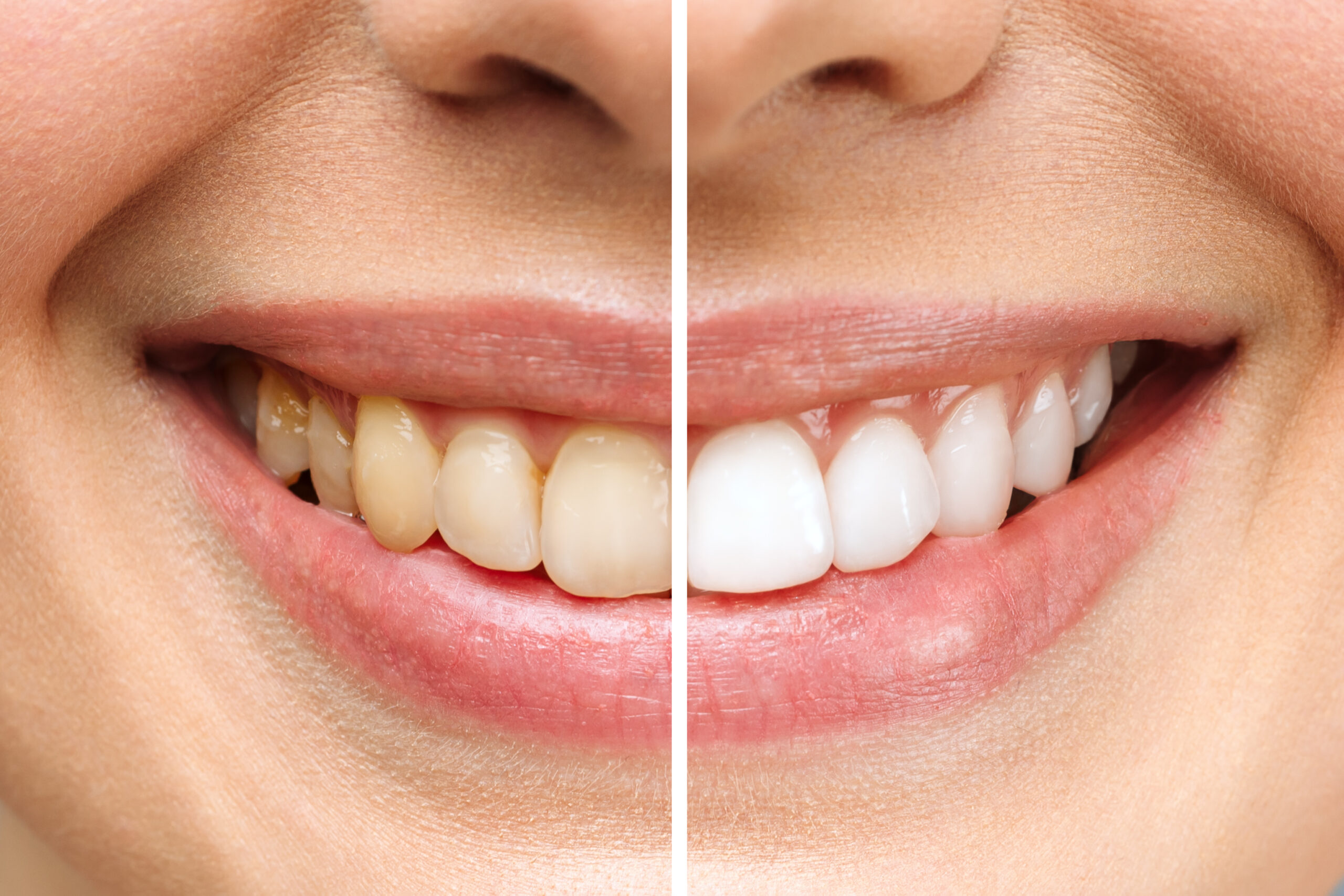 Woman Teeth Before After Whitening White Background Dental Clinic Patient Image Symbolizes Scaled