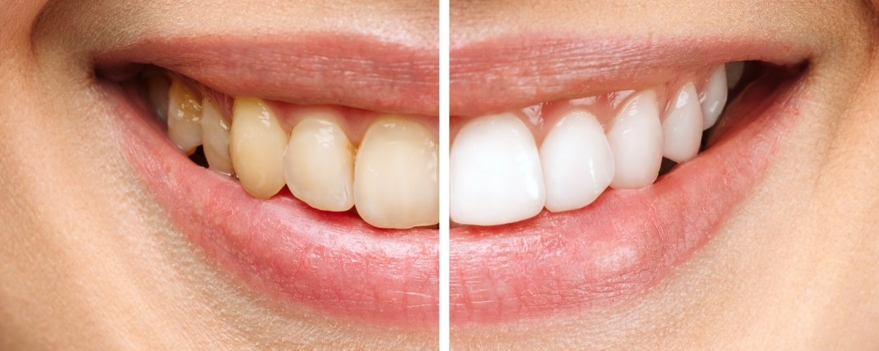 •Peri Implant Implant Cevresi Hastaliklar Ve Agiz Bakimi